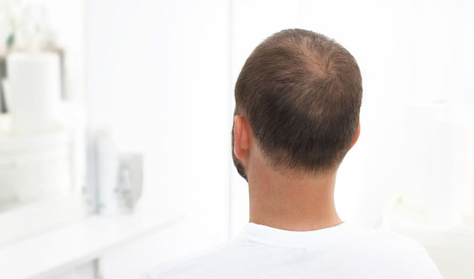 5 different reasons for thin hair in men