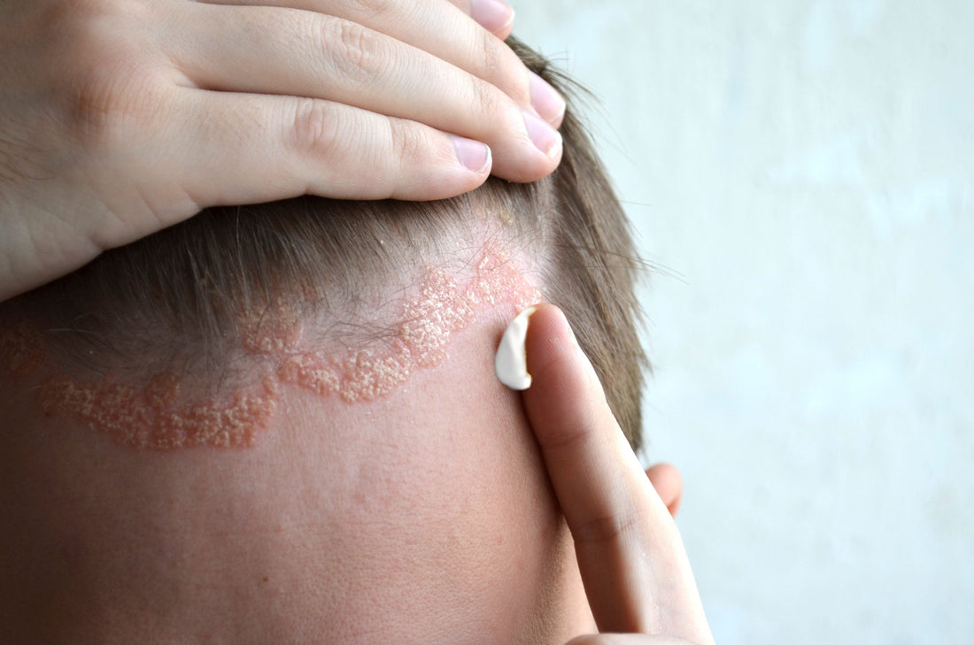 A close of someone applying a cream treatment to their scalp psoriasis