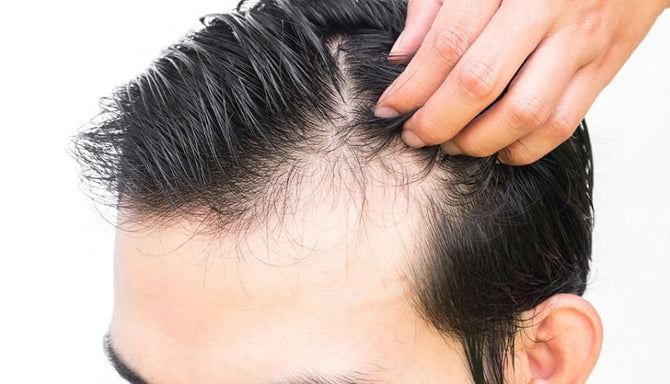 Fever: Hair loss as a side effect?