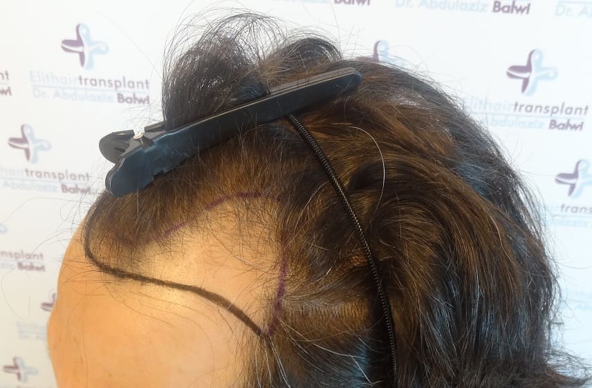 Haarausfall durch Sauerstoffmangel