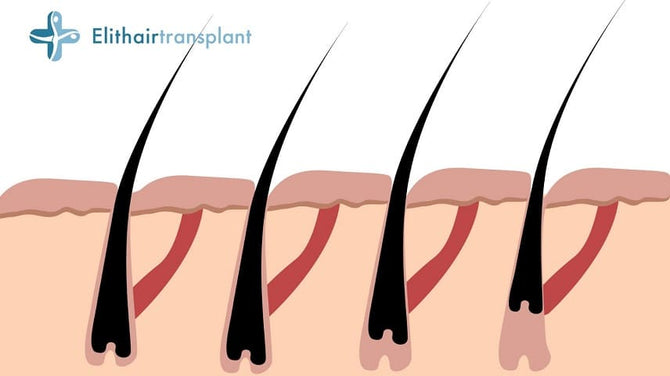 Hair loss with root