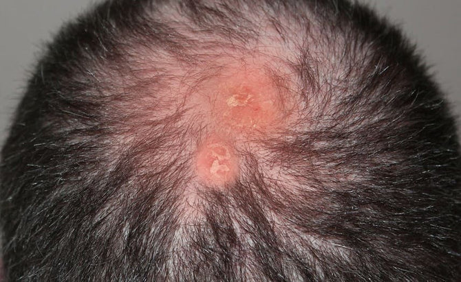 Gibt es bei Folliculitis decalvans eine Therapie?