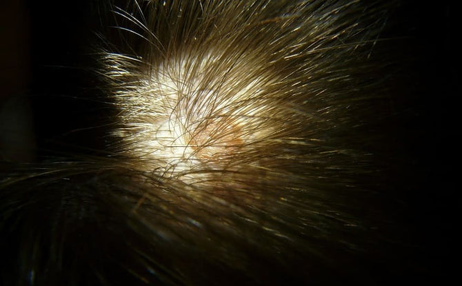Lichen planus with hair loss: What treatment is possible?