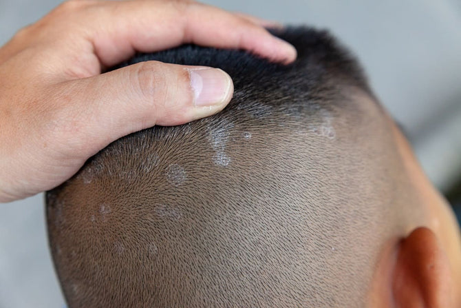 Hair loss due to pityriasis rosea - causes and treatment