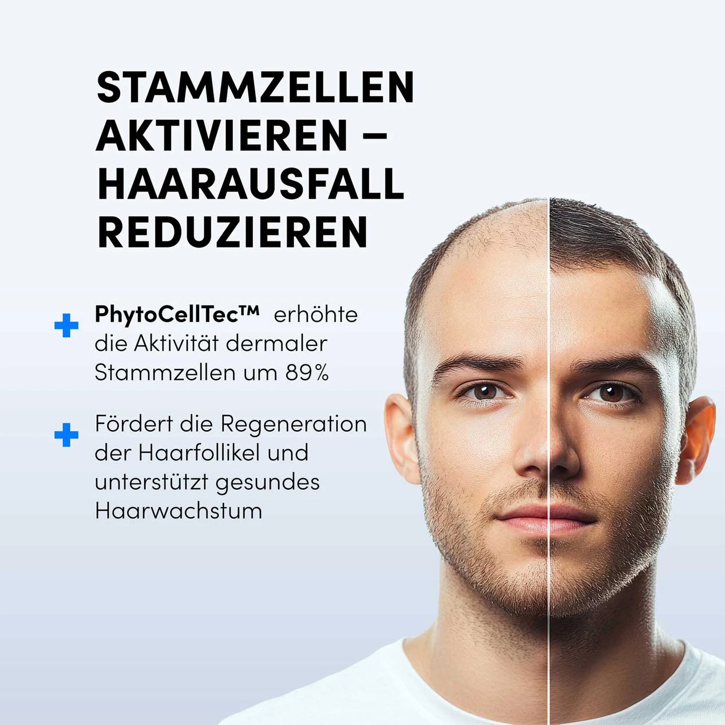Das Gesicht eines jungen Mannes ist in zwei Hälften geteilt: links ist Haarausfall zu sehen, rechts ist das Haar voller. Der deutsche Text bewirbt das Dr. Balwi Meso Therapie Set aus dem Dr. Balwi Shop für Microneedling und Stammzellenaktivierung zur Reduzierung von Haarausfall und zur Unterstützung des Wachstums.