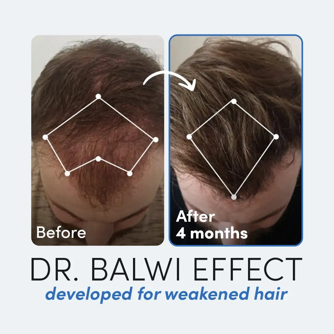 Dr Balwi Mesotherapy Set