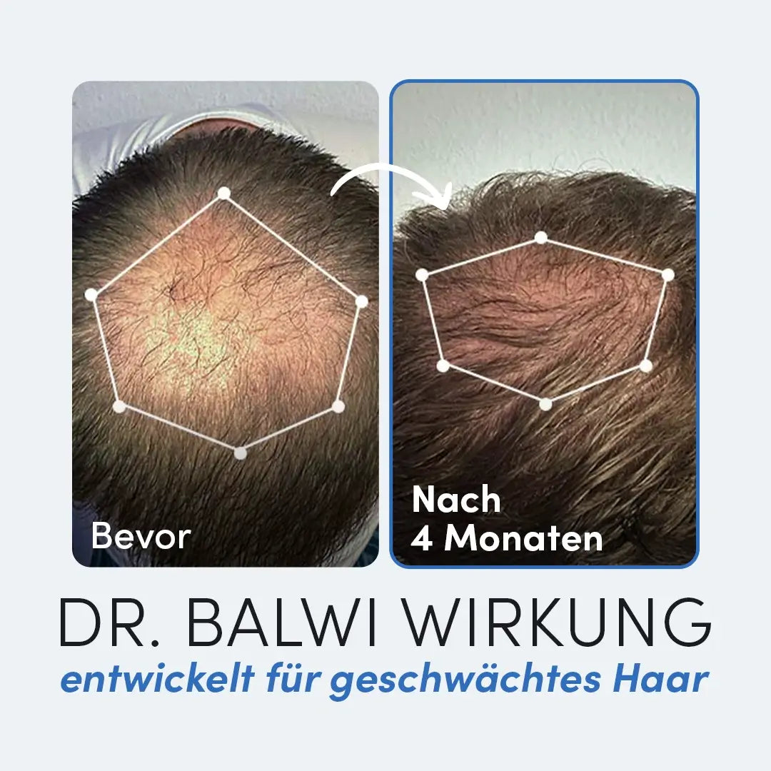 Zwei nebeneinander liegende Fotos der Kopfhaut einer Person zeigen dünneres Haar (links, "Bevor") und volleres Haar (rechts, "Nach 4 Monaten"). Text: Mit Multivitamin Complex von Dr. Balwi Shop - entwickelt zur Stärkung geschwächter Haare.