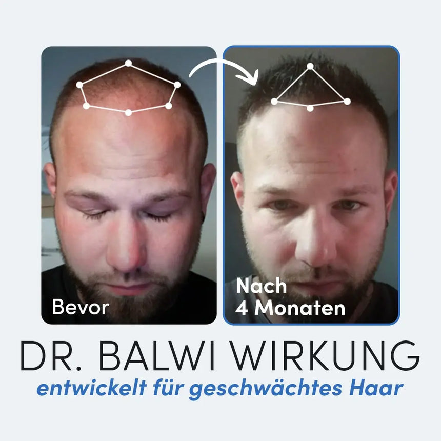 Nebeneinander liegende Fotos eines Mannes: links mit der Aufschrift "Bevor" mit schütterem Haar, rechts mit der Aufschrift "Nach 4 Monaten" mit glattem Haar. Unten: Dr. Balwi Styling & Repair Creme von Dr. Balwi Shop mit Arganöl für geschwächtes Haar.
