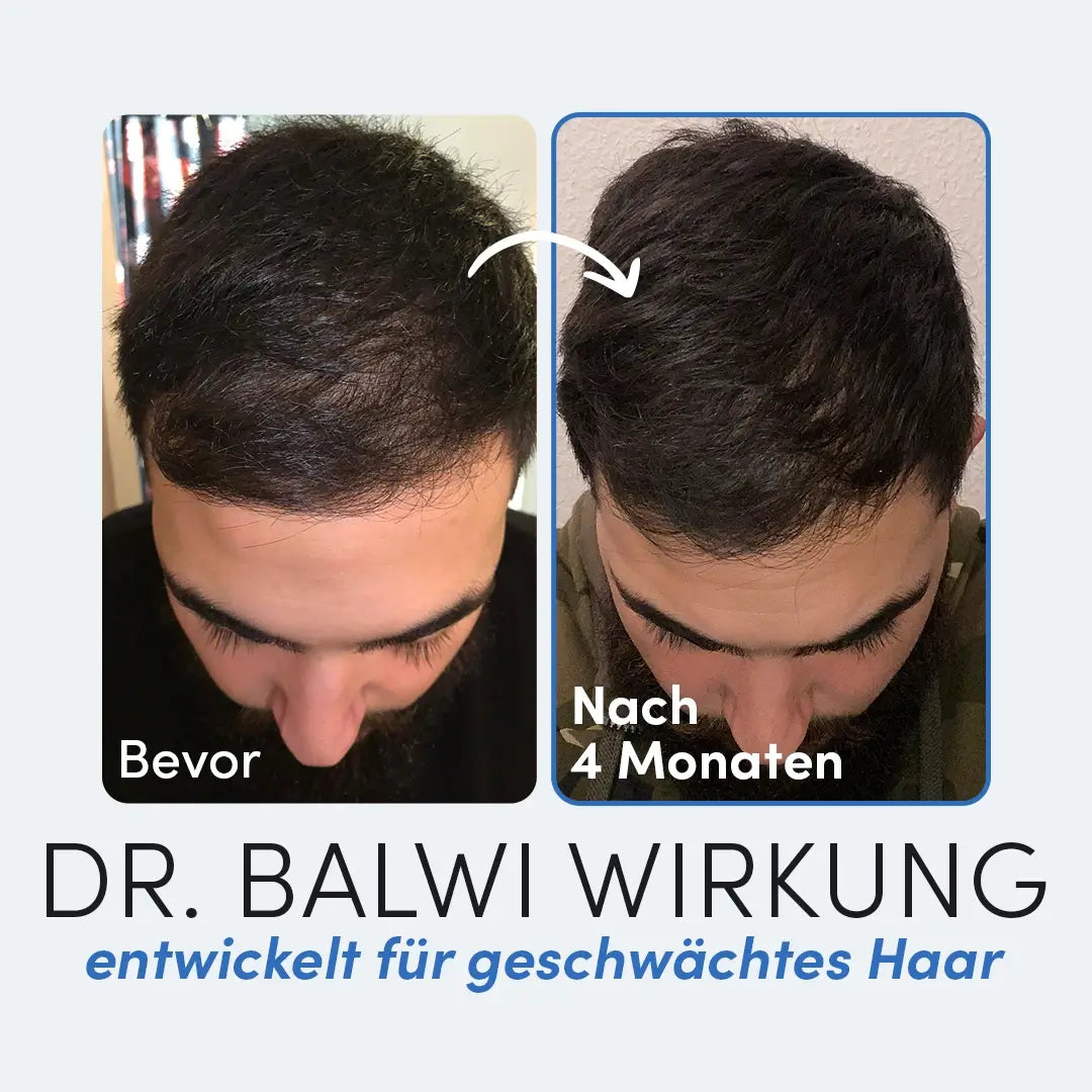 Nebeneinander liegende Fotos von oben: Links, "Bevor", mit schütterem Haar und trockener Kopfhaut; rechts, "Nach 4 Monaten", zeigt volleres Haar. Text: Dr. Balwi Shop - 98% Aloe Vera entwickelt für geschwächtes Haar.