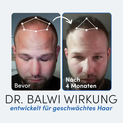Seite an Seite Fotos der Kopfhaut eines Mannes vor und nach 4 Monaten Anwendung der Anti-Haarausfall-Routine von Dr. Balwi Shop. Links: deutliche Ausdünnung; rechts: sichtbar volleres Haar. Weiße Linien umreißen den Haaransatz. Text: Bevor, nach 4 Monaten, Dr. Balwi Wirkung.