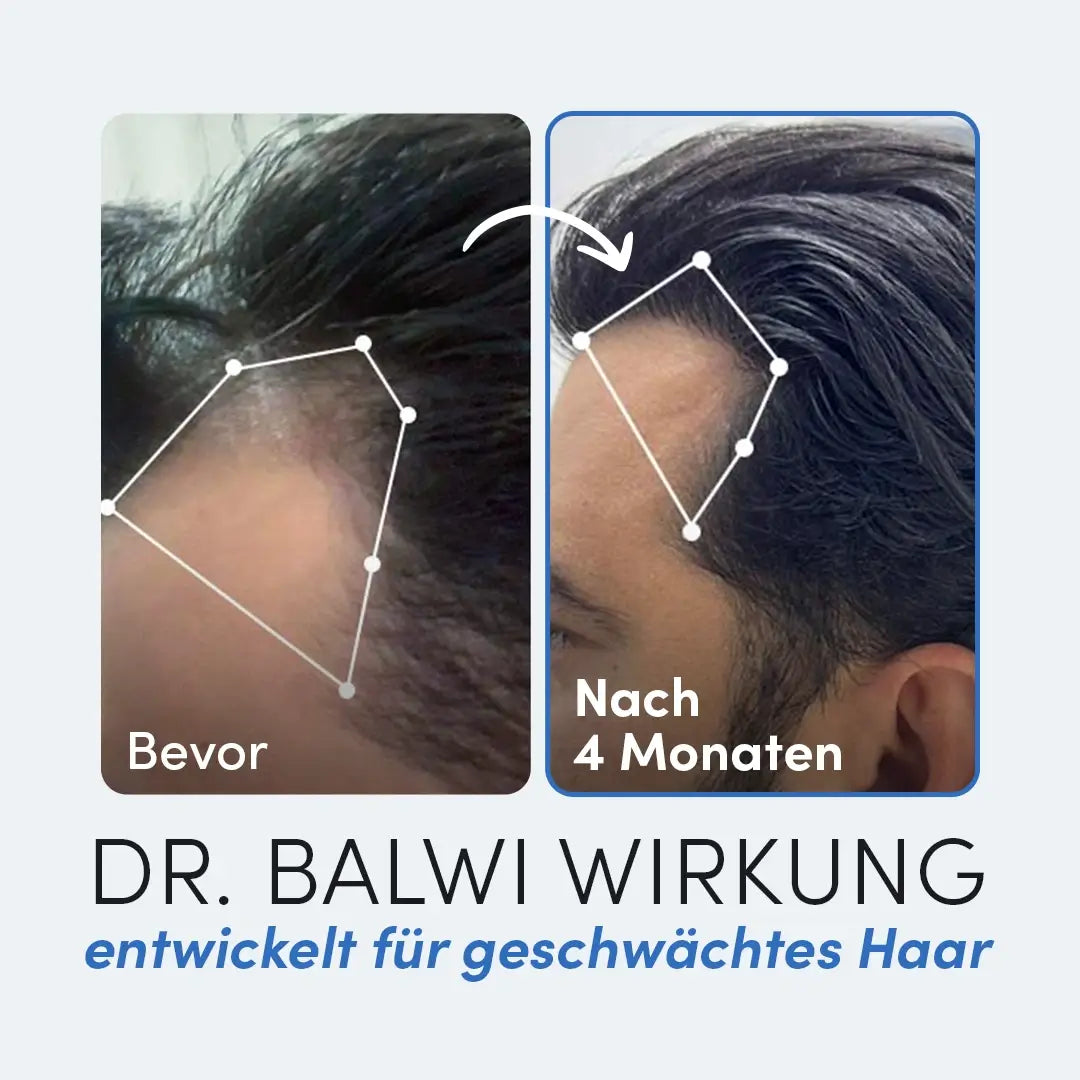 Nebeneinanderstehende Fotos zeigen den Haaransatz eines Mannes vor und nach 4 Monaten mit dem Dr. Balwi Hair Boost Set aus dem Dr. Balwi Shop und offenbaren mehr Haardichte und sichtbares Haarwachstum - entwickelt für geschwächtes Haar.