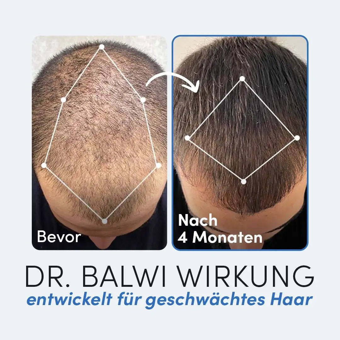Draufsicht auf den Kopf eines Mannes vor und nach 4-monatiger Anwendung des Dr. Balwi Shampoos aus dem Dr. Balwi Shop: links schütteres Haar, rechts gesundes Nachwachsen. Text: Vor & Nach 4 Monaten, mit geometrischen Umrissen, die den Bereich markieren.